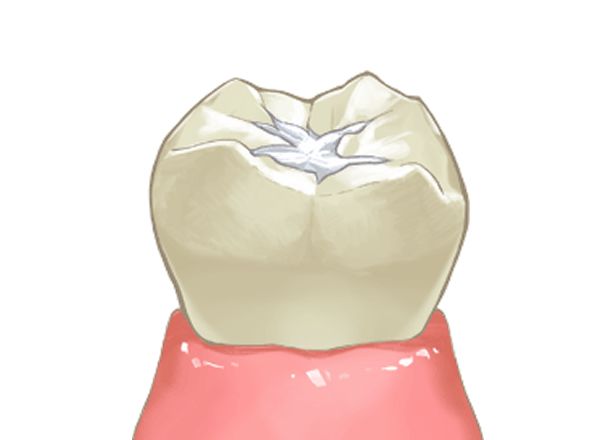 シーラント